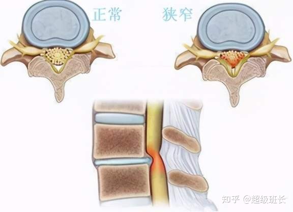 腰椎管狹窄手術(shù)成功率高嗎？都是怎樣做的？