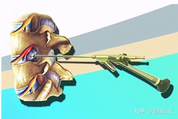 腰椎管狹窄手術(shù)成功率高嗎？都是怎樣做的？