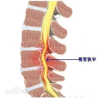 什么是腰椎管狹窄癥？