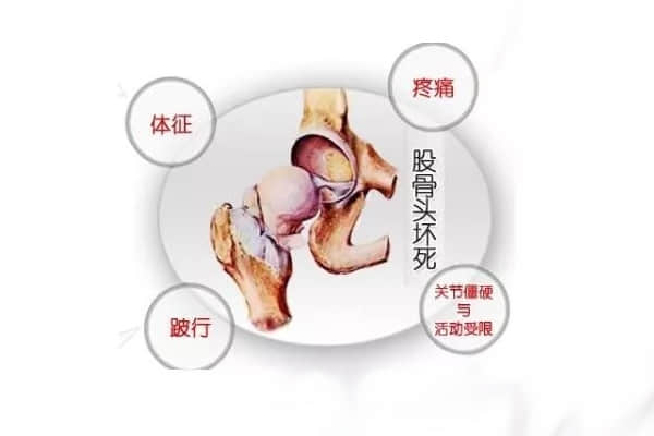 股骨頭壞死五大疑問(wèn)，你真的都懂了么？