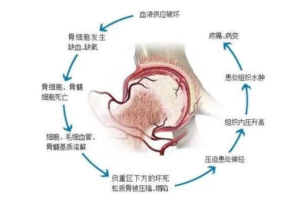 股骨頭壞死后股骨頭變形、塌陷怎么辦？
