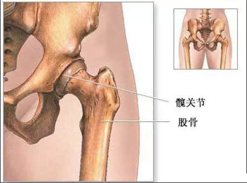 蓮池骨科醫(yī)院-股骨頭壞死患者，哪些情況下要做置換手術(shù)了？