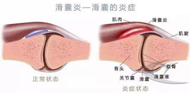 蓮池骨科醫(yī)院 滑囊炎
