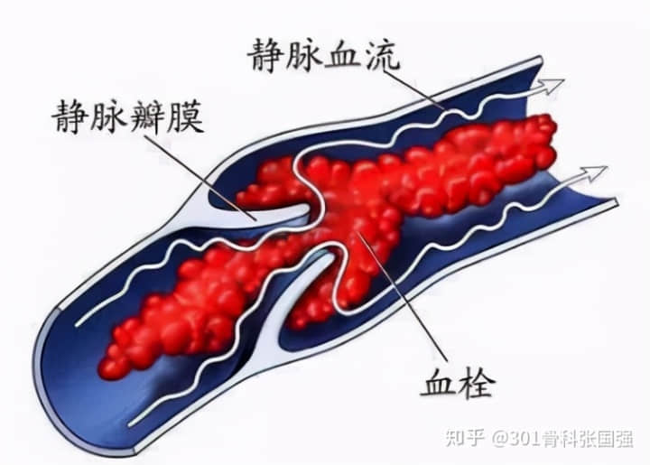 年齡「越大」，膝關(guān)節(jié)置換手術(shù)風(fēng)險(xiǎn)「越高」嗎？