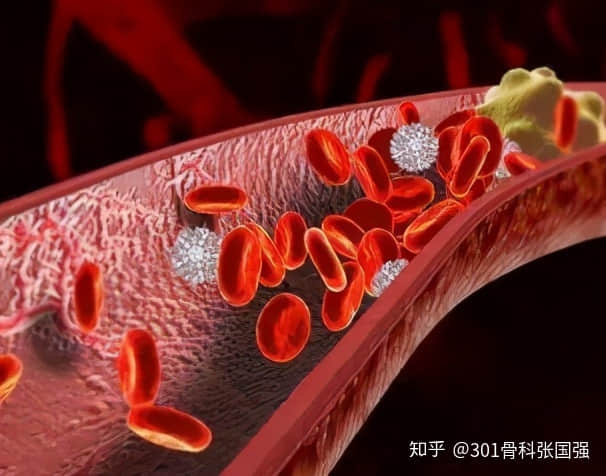 年齡「越大」，膝關(guān)節(jié)置換手術(shù)風(fēng)險(xiǎn)「越高」嗎？