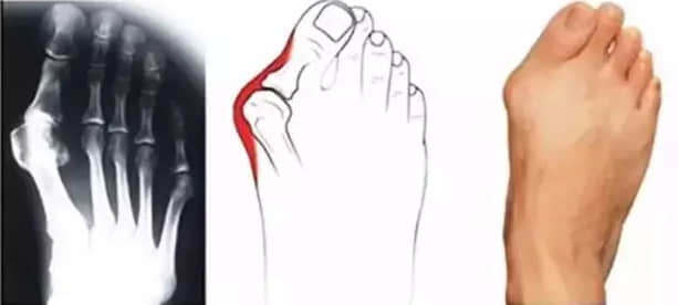 關(guān)于拇外翻，讀懂這一篇就夠了