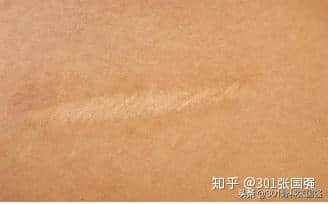 髖關(guān)節(jié)置換的潘多拉魔盒——術(shù)后下肢長(zhǎng)短的幾種特殊情況