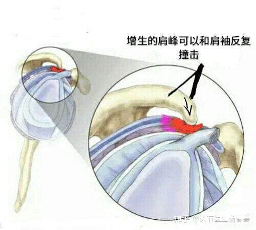 肩袖損傷與肩周炎可以用關(guān)節(jié)鏡治療嗎？