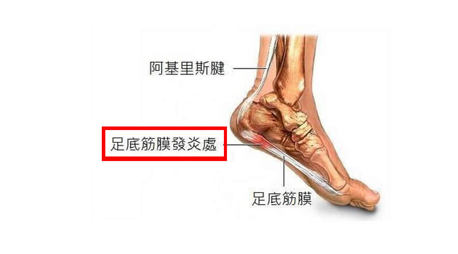 哪些人或者哪些習慣 容易患足底筋膜炎？