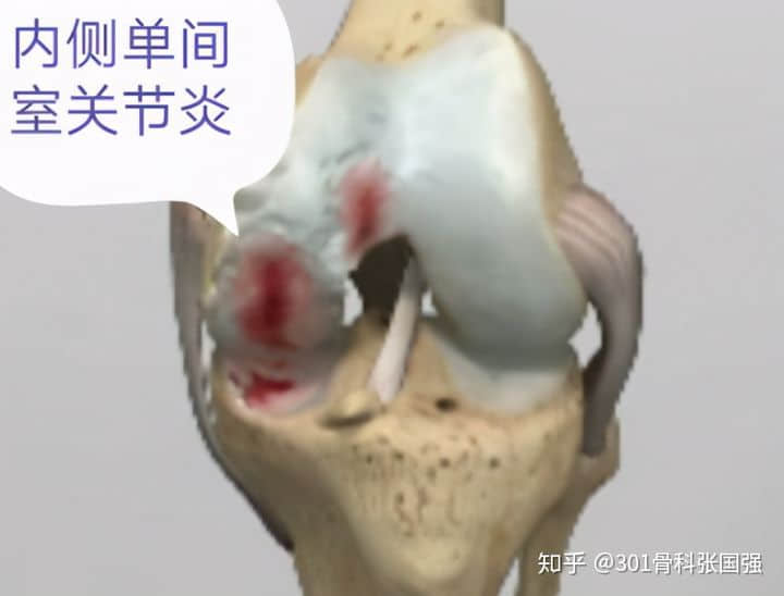 只有膝關(guān)節(jié)內(nèi)側(cè)疼也要換膝關(guān)節(jié)嗎？