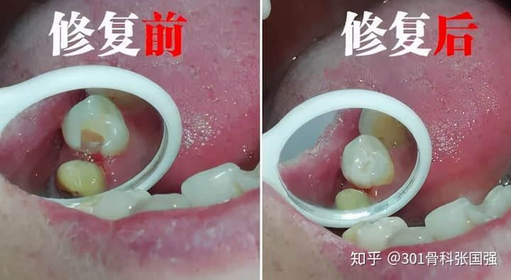 只有膝關(guān)節(jié)內(nèi)側(cè)疼也要換膝關(guān)節(jié)嗎？