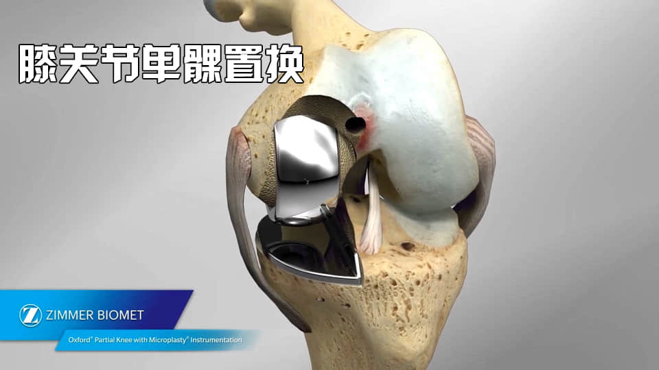 膝蓋疼醫(yī)生建議換一半關節(jié)
