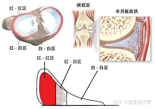半月板損傷了，選擇修復(fù)還是切除？