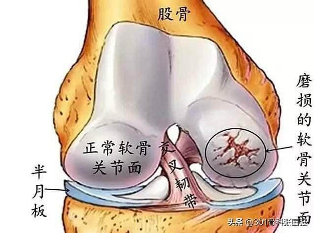 膝關(guān)節(jié)軟骨磨損了能復(fù)原嗎？