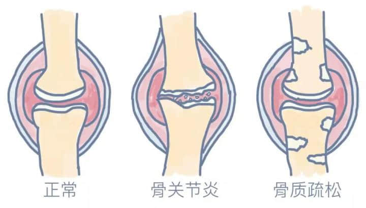 膝骨關(guān)節(jié)炎是一種老年常見(jiàn)病，多見(jiàn)于50歲以上人群，是引起老年人疼痛和殘疾的主要原因，常導(dǎo)致患者生活質(zhì)量下降。在門(mén)診中，我們經(jīng)常會(huì)碰到這樣的患者或家屬，他們關(guān)切的問(wèn)道：這個(gè)病能根治嗎，需要怎么治療？可以看出很多人對(duì)這一疾病還缺乏基本的認(rèn)知。

下面，我們來(lái)全面認(rèn)識(shí)下什么是膝骨關(guān)節(jié)炎。

★膝骨關(guān)節(jié)炎的概念★

膝骨關(guān)節(jié)炎還有一種說(shuō)法叫膝關(guān)節(jié)退行性變，通俗點(diǎn)說(shuō)就是關(guān)節(jié)老化了，這種老化的根源是關(guān)節(jié)軟骨的老化。

正常膝關(guān)節(jié)表面都有一層厚度約為3-5mm的軟骨，關(guān)節(jié)軟骨非常光滑，起到潤(rùn)滑、緩沖應(yīng)力的作用。

隨著年齡增長(zhǎng)軟骨會(huì)逐漸變薄，如果再伴有這些因素，比如：外傷，關(guān)節(jié)受力異常，韌帶或半月板損傷，先天發(fā)育不良，體重過(guò)大等，就會(huì)加速軟骨的磨損老化。

關(guān)節(jié)軟骨結(jié)構(gòu)的完整性非常重要，一旦損傷，會(huì)導(dǎo)致關(guān)節(jié)腫脹和疼痛，加速破壞，發(fā)展成骨關(guān)節(jié)炎。

由于關(guān)節(jié)軟骨中沒(méi)有血管，其營(yíng)養(yǎng)物質(zhì)依靠關(guān)節(jié)液供應(yīng)，其本身也不含可以分化再生的細(xì)胞，一旦損傷后很難自我修復(fù)或再生。

雖然近幾年來(lái)對(duì)于軟骨修復(fù)和軟骨再生的研究有了一些成果，但現(xiàn)階段來(lái)看，對(duì)于老年骨關(guān)節(jié)炎的軟骨再生是不可能的。








圖：左側(cè)為健康的膝關(guān)節(jié)（軟骨完整），右側(cè)為骨關(guān)節(jié)炎的膝關(guān)節(jié)炎（軟骨破壞）

所以說(shuō)膝骨關(guān)節(jié)炎是不可能治愈的，但是對(duì)于不同嚴(yán)重程度的膝骨關(guān)節(jié)炎，通過(guò)正確有效的治療，可以緩解或消除疼痛，延緩關(guān)節(jié)老化速度，改善或恢復(fù)關(guān)節(jié)功能，提高患者的生活質(zhì)量，實(shí)現(xiàn)臨床治愈。

那么該如何正確有效的治療呢？

★膝骨關(guān)節(jié)炎的治療★

膝骨關(guān)節(jié)炎可根據(jù)疼痛及對(duì)日常活動(dòng)的影響程度分為初期、早期、中期和晚期，針對(duì)不同分期，有不同的治療策略。








中華醫(yī)學(xué)會(huì)《骨關(guān)節(jié)炎診療指南》2018 年版，針對(duì)不同分期的膝骨關(guān)節(jié)炎提出基礎(chǔ)治療、藥物治療、修復(fù)性治療和重建治療四層次的金字塔型的階梯治療策略。

基礎(chǔ)治療
基礎(chǔ)治療包括：健康教育，運(yùn)動(dòng)治療，物理治療和行為支持治療。對(duì)癥狀較輕的初期患者這是首選的治療方式。強(qiáng)調(diào)改變生活及工作方式的重要性，使患者樹(shù)立正確的治療目標(biāo)，減輕疼痛、改善和維持關(guān)節(jié)功能，延緩疾病進(jìn)展。

藥物治療
按藥物使用途徑分為外用藥物、口服藥物、關(guān)節(jié)腔內(nèi)注射藥物等。

口服藥物：在使用口服藥物前，建議先選擇局部外用藥物，尤其是老年人，可使用各種NSAIDs類(lèi)藥物的凝膠貼膏、乳膠劑、膏劑、貼劑等，如氟比洛芬凝膠貼膏、扶他林乳膏等?？诜幬镏凶畛Ｓ玫氖荖SAIDs類(lèi)鎮(zhèn)痛藥，但要注意NSAIDs類(lèi)藥物過(guò)量使用并不能增強(qiáng)療效、可能會(huì)增加毒副反應(yīng)。

關(guān)節(jié)腔注射藥物：對(duì)早中期可緩解疼痛，改善關(guān)節(jié)功能，但該方法是侵入性治療，可能會(huì)增加感染的風(fēng)險(xiǎn)，必須嚴(yán)格無(wú)菌操作及規(guī)范操作，而且最新的國(guó)際指南并不推薦關(guān)節(jié)腔注射。

手術(shù)治療
修復(fù)性治療包括：關(guān)節(jié)鏡手術(shù)，關(guān)節(jié)軟骨修復(fù)術(shù)及生物治療，膝關(guān)節(jié)周?chē)毓切g(shù)。

關(guān)節(jié)鏡清理：主要針對(duì)伴有“膝關(guān)節(jié)卡頓”或半月板撕裂等癥狀的患者，通過(guò)關(guān)節(jié)鏡下摘除游離體、清理半月板碎片及增生的滑膜等，能減輕部分早中期患者的癥狀，但有研究認(rèn)為其遠(yuǎn)期療效與保守治療相當(dāng)，最新的國(guó)際指南也不推薦關(guān)節(jié)鏡手術(shù)作為癥狀性骨關(guān)節(jié)炎患者的治療手段。

關(guān)節(jié)軟骨修復(fù)術(shù)及生物治療:療效尚需進(jìn)一步研究探索。

膝關(guān)節(jié)周?chē)毓切g(shù)：是經(jīng)典的保膝治療手段，最常用的是脛骨高位截骨術(shù)（HTO）。該方法通過(guò)改變力線來(lái)改變關(guān)節(jié)面的接觸面，就像是一顆小樹(shù)長(zhǎng)歪了，我們通過(guò)外力把它變直。該方法可以有效緩解甚至消除疼痛，大部分患者可不需再行關(guān)節(jié)置換。該方法適合青中年活動(dòng)量大、力線不佳的患者。


重建性手術(shù)：主要是人工關(guān)節(jié)置換術(shù)，包括膝關(guān)節(jié)部分置換術(shù)（單髁置換術(shù)）和全膝關(guān)節(jié)置換術(shù)。


單髁置換術(shù)：適用于當(dāng)膝關(guān)節(jié)的軟骨只有一個(gè)地方受累，而且關(guān)節(jié)韌帶功能完好的情況下。這是一種微創(chuàng)手術(shù)，該技術(shù)能盡可能保留正常的關(guān)節(jié)結(jié)構(gòu)，具有創(chuàng)傷小，恢復(fù)快，術(shù)后關(guān)節(jié)自我感覺(jué)好等優(yōu)點(diǎn)，十年優(yōu)良率在95%左右。但是當(dāng)關(guān)節(jié)軟骨多個(gè)部分或全部都受累時(shí)，單髁置換就不能解決問(wèn)題了。這時(shí)需要全膝關(guān)節(jié)置換。


全膝關(guān)節(jié)置換術(shù)：是針對(duì)終末期骨關(guān)節(jié)炎成熟且有效的治療方法，尤其是伴有各種嚴(yán)重畸形時(shí)，能非常有效的解除患者病痛，極大提高患者生活質(zhì)量。術(shù)后絕大多數(shù)患者遠(yuǎn)期效果滿意，15-20年假體生存率可達(dá)90%。

結(jié)語(yǔ)
隨著人類(lèi)壽命的延長(zhǎng)，人口老齡化，骨關(guān)節(jié)炎的發(fā)生率逐年增加，嚴(yán)重影響人們的生活質(zhì)量和健康，給社會(huì)造成巨大的經(jīng)濟(jì)負(fù)擔(dān)和壓力。所以，從年輕時(shí)我們就該引起重視，預(yù)防骨關(guān)節(jié)炎的發(fā)生。在出現(xiàn)癥狀的骨關(guān)節(jié)炎初期、早期，要正確認(rèn)識(shí)，通過(guò)積極的基礎(chǔ)治療和藥物治療，盡可能減緩病情進(jìn)展。

當(dāng)中晚期時(shí)，要根據(jù)病情、年齡、社會(huì)活動(dòng)的不同層次，以及關(guān)節(jié)間室累及情況，選擇合適的手術(shù)方案。特別是當(dāng)疼痛癥狀較重，嚴(yán)重影響生活質(zhì)量時(shí)，應(yīng)盡早進(jìn)行手術(shù)治療，而不是往后拖。