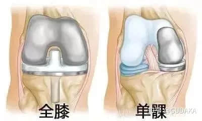 膝關(guān)節(jié)還能換半邊？UKA單髁置換是什么