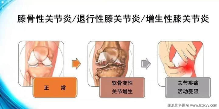 膝骨性關(guān)節(jié)炎，“保膝”“換膝”如何選？