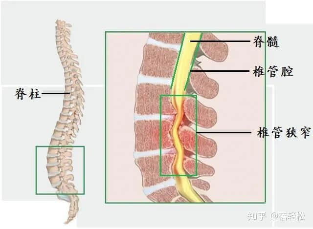 椎管狹窄是什么意思？嚴(yán)重嗎?