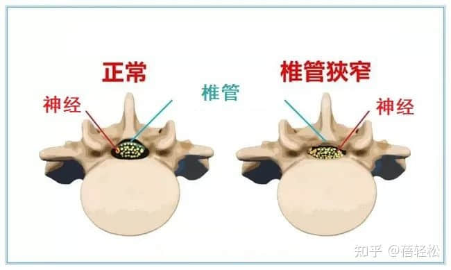 椎管狹窄是什么意思？嚴(yán)重嗎?