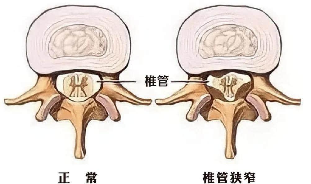 腰椎椎管狹窄癥？試試UBE技術(shù)！