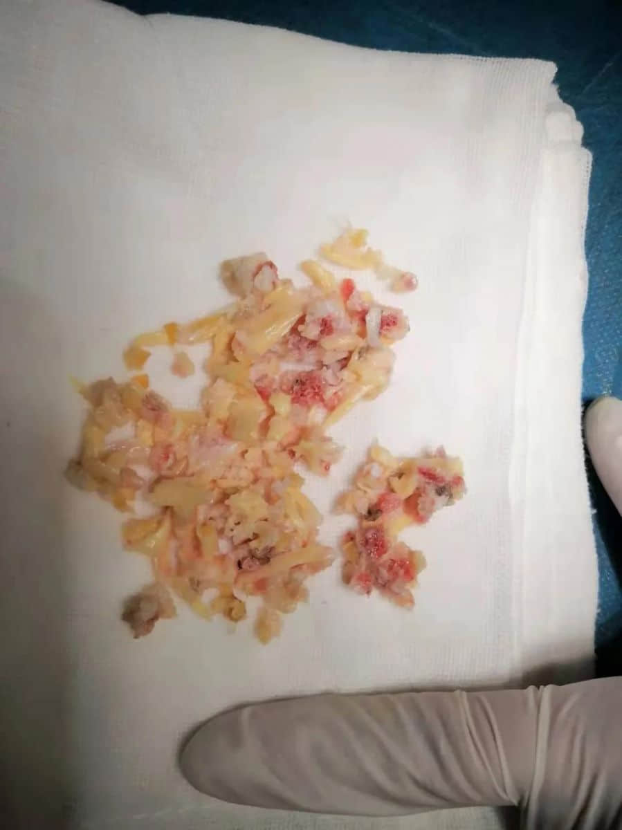 腰椎椎管狹窄癥？試試UBE技術(shù)！