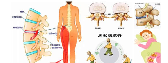 老年腰突癥與年輕患者有什么不同？哪些方法更適合？